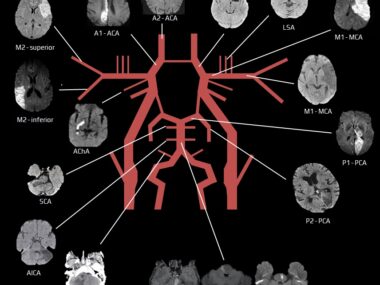 Stroke: Types, Areas of Infarction, and Clinical Presentations